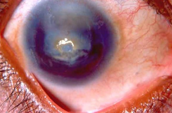 Tật dị mống mắt (aniridia) là một chứng rối loạn di truyền, người mắc phải bệnh này là người hỏng giác mạc bẩm sinh. Bệnh này có thể khiến người mắc bị mù và đôi mắt của họ trông rất quái dị. 