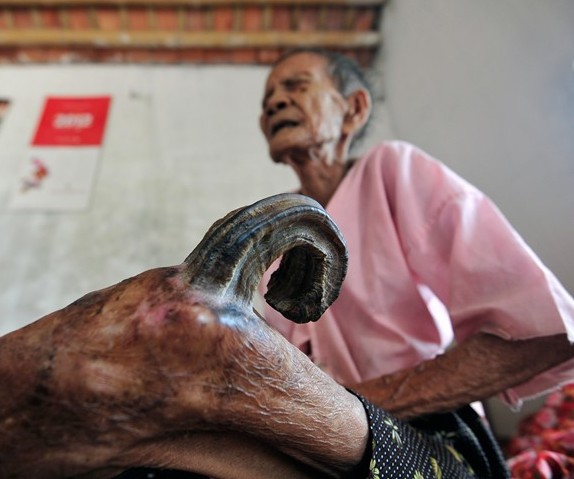 Sừng cong vút mọc ở chân, cụ bà người Nam Định thọ gần 100 tuổi - Ảnh 2