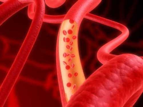 Mỡ máu cao gây ra xơ vữa và tắc nghẽn động mạch