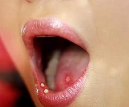 Loét miệng lâu ngày, khó lành có thể là biểu hiện của ung thư lưỡi (Ảnh minh họa)
