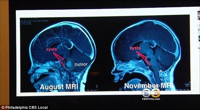 
Kết quả giữa tháng 8 và tháng 11 phim chụp não cho thấy kết quả khác biệt hoàn toàn.
