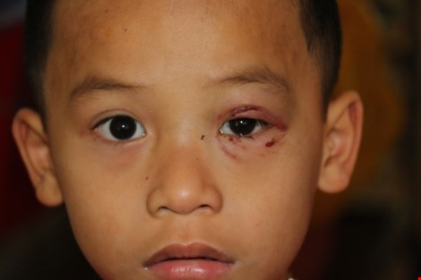 Cháu bé con anh Võ cũng bị đánh bầm mắt.
