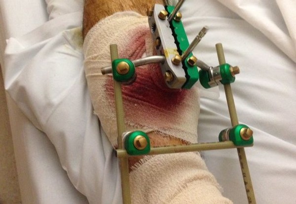 Hình ảnh chiếc chân bị băng bó của Parsons sau chấn thương kinh hoàng.