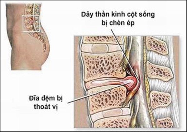 Thoát vị đĩa đệm cột sống là một nguyên nhân gây đau thắt lưng.