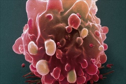 Sự phát triển của tế bào ung thư trong cơ thể người