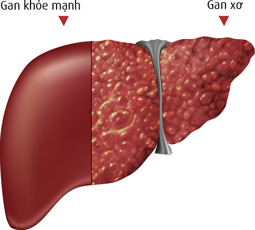 Hình ảnh gan bị xơ.