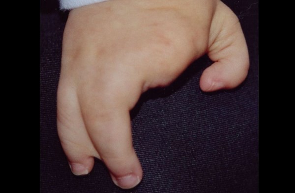 Hội chứng tay càng tôm hùm (Ectrodactyly) là hội chứng mà những người mắc phải bị mất đi một số ngón tay, ngón chân và những ngón còn lại dính vào nhau tạo nên hình dáng giống như càng tôm hùm. Tỷ lệ trẻ sơ sinh mắc bệnh này cũng khá cao và có thể phẫu thuật tách ngón 