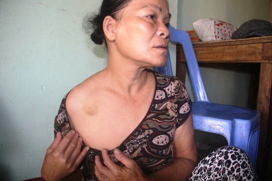 Bà Thảo khẳng định vết bầm trên ngực do nhóm “giang hồ” gây ra lúc 2 bên giằng co