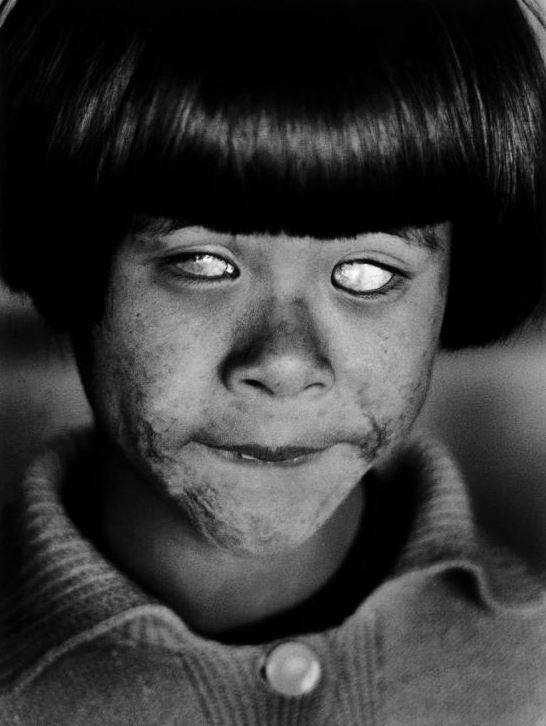 Đôi mắt của nạn nhân vụ nổ bom nguyên tử Hiroshima. Cô bé này là một người may mắn sống sót sau vụ Mỹ thả bom xuống thành phố Hiroshima, tuy nhiên cô bị bỏng nặng toàn thân và mất đi thị giác.