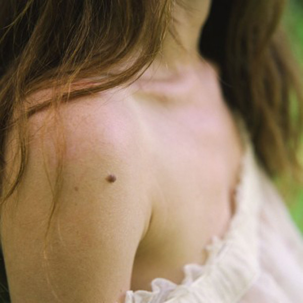 Phụ nữ có dấu hiệu này trên da, nguy cơ ung thư vú cực cao