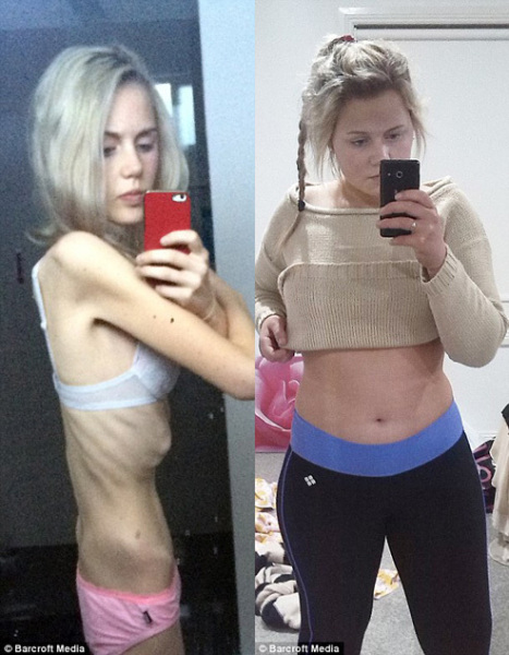 
Elle trước và sau khi bị bệnh.
