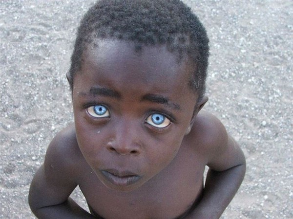 Tấm ảnh Cậu bé với đôi mắt Sapphire này bị cáo buộc là đã qua chỉnh sửa Photoshop, tuy nhiên tác giả của bức ảnh, nhiếp ảnh gia Vanessa Bristow đã chứng minh được bức hình là có thật thông qua nhiều góc chụp khác. Nhiều nhà khoa học cho rằng đôi mắt của cậu bé là do chứng bạch tạng tại mắt gây ra.