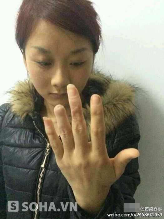 Ngón nhẫn của cô Dương Lệ Hoa bị cảnh sát đánh gãy lìa.