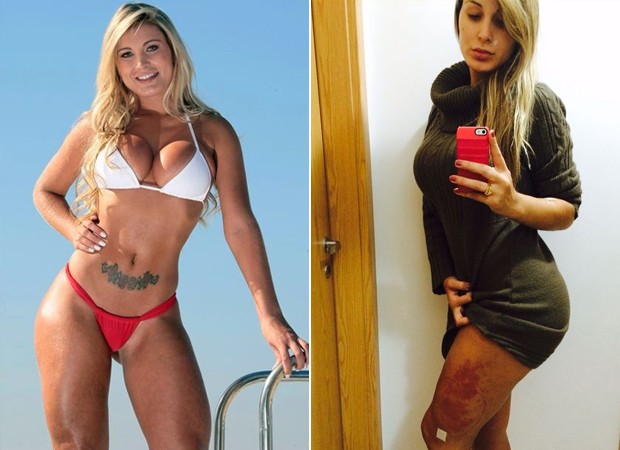 Đôi chân của Andressa Urach lành lặn trong quá khứ và ở giai đoạn đầu phát bệnh.