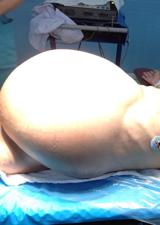 Khối u nặng 19 kg trong bụng bệnh nhân N. trước khi mổ (Ảnh Bệnh viện)