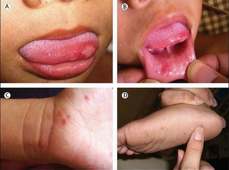 Những hình ảnh trẻ bị bệnh tay chân miệng (Ảnh minh họa: Internet)