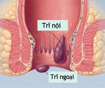 
Hình ảnh mô tả bệnh trĩ.
