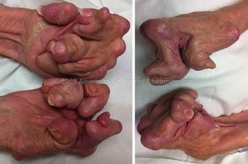 Tay của người bệnh gout giai đoạn cuối