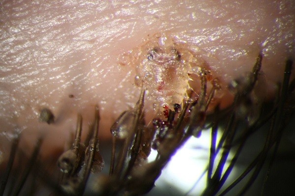 Rận mu thường ký sinh ở vùng lông mu, lông mi, lông mày, thậm chí là trên da đầu của người bệnh.