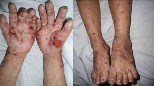 Bệnh viêm da lòng bàn tay, bàn chân như trường hợp ở nước ta (Quảng Ngãi), trên bàn tay - chân của người mắc bệnh có nhiều vết như bị bỏng, từng vùng da sậm lại, rộp lên, to nhỏ xem kẽ.