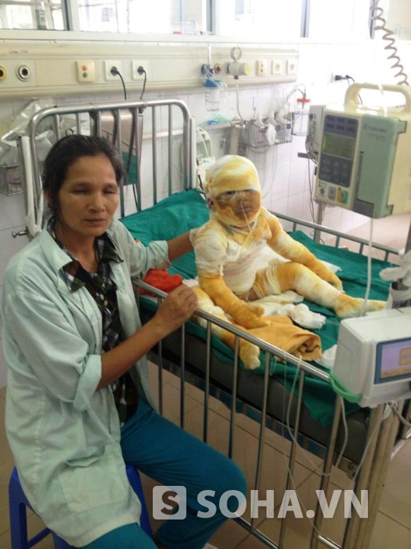 Cháu Thảo (3 tuổi) bị bỏng nặng đang được điều trị.