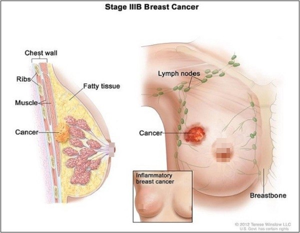 Mô hình ung thư vú