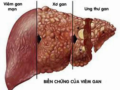 Viêm gan là nguyên nhân hàng đầu dẫn đến ung thư gan