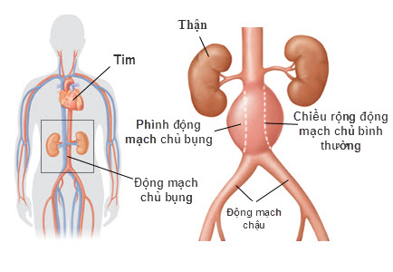 Hình ảnh phình động mạch chủ bụng.