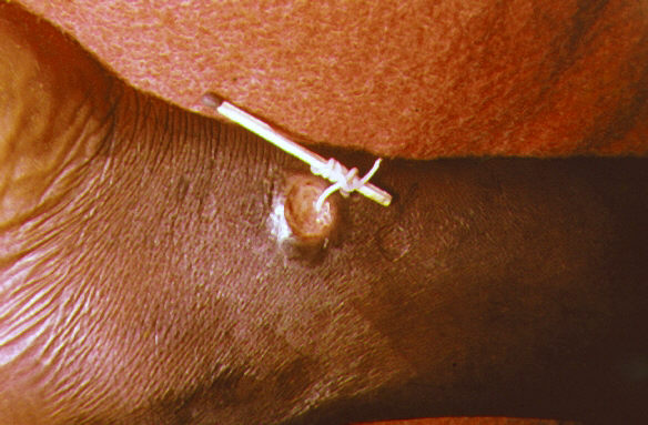 Những hình ảnh rợn người khi kéo giun chỉ Guinea ra khỏi cơ thể (Ảnh minh họa: Internet)