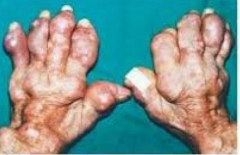 
Ảnh bệnh nhân bị gout do biến chứng của béo phì.
