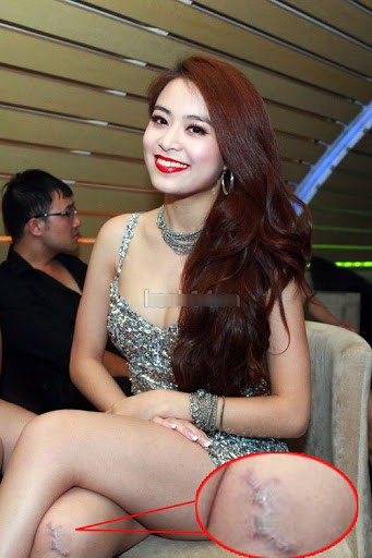Một trong số những mỹ nhân sexy của làng nhạc Việt - Hoàng Thùy Linh cũng sở hữu đôi chân kém thon gọn với vết sẹo lồi sẫm màu khá lớn ở đầu gối.