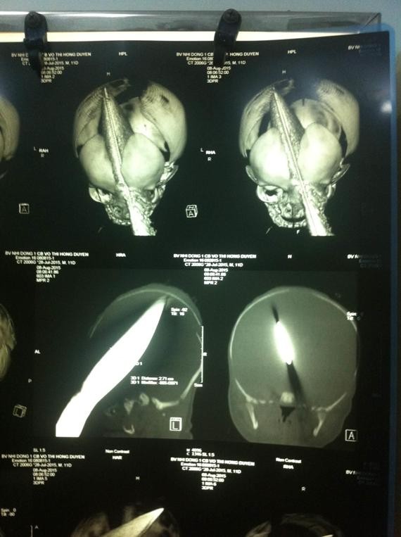Kết quả chụp CT trước khi tiến hành phẫu thuật. (Ảnh do bệnh viện cung cấp)