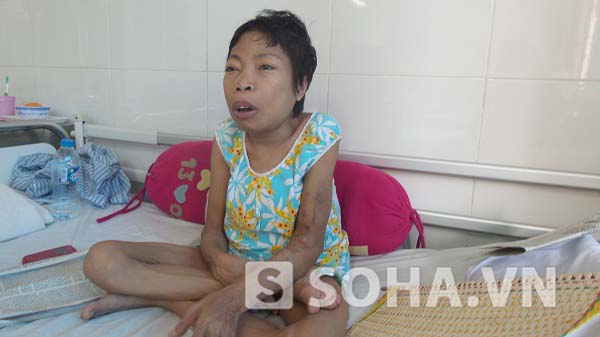 Chị Loan trong những ngày điều trị tại Bệnh viện đa khoa Xanh Pôn. (Ảnh: Nguyễn Huệ)