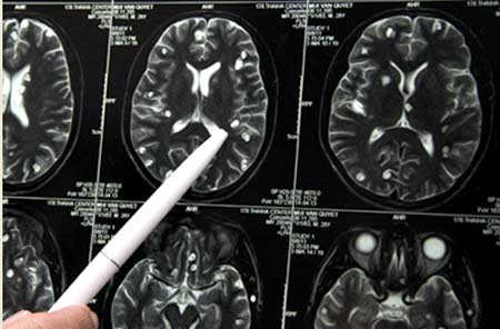Hình ảnh não nhiễm chi chít sán của bệnh nhân mê ăn tiết canh (Nguồn: Dân trí)