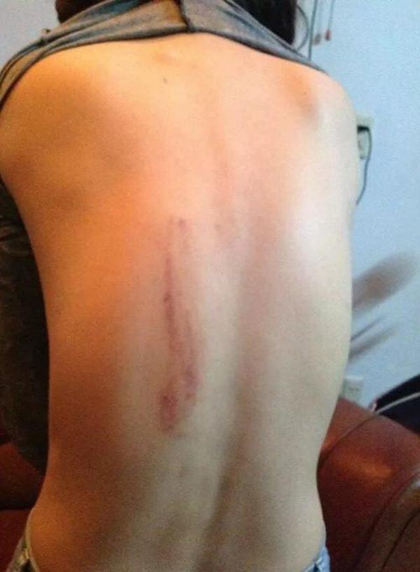 Hình ảnh vết thương ở lưng của Dương Yến Ngọc.
