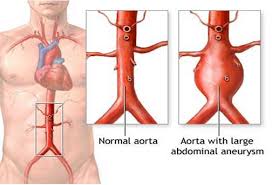 Hình ảnh động mạch chủ bị phình.