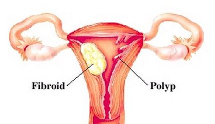 Hình ảnh polyp tử cung.