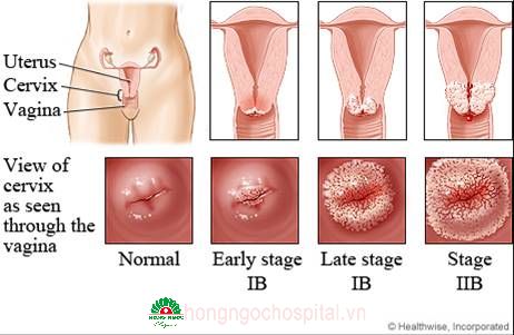 
Các giai đoạn ung thư cổ tử cung.
