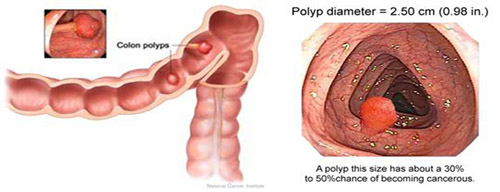 Hình ảnh polyp đại - trực tràng.