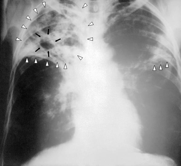 Phim X-Quang của người bệnh lao phổi