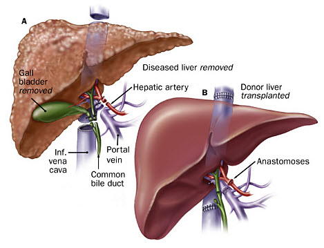 Hình ảnh gan khỏe mạnh và gan bị ung thư (Ảnh minh họa)