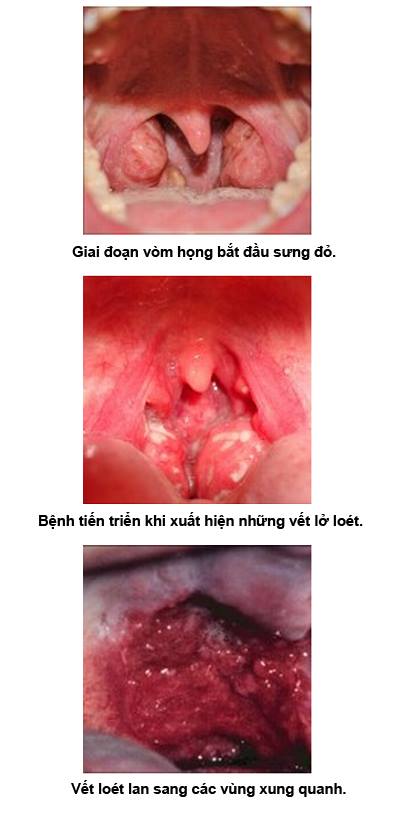 Căn bệnh cực kỳ đáng sợ mà người hay ăn dưa, cà muối có thể mắc phải