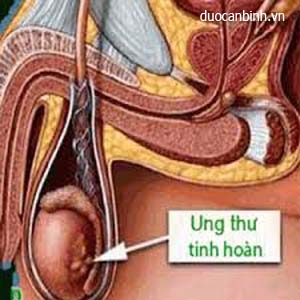 Ung thư tinh hoàn: Nỗi ám ảnh của quý ông