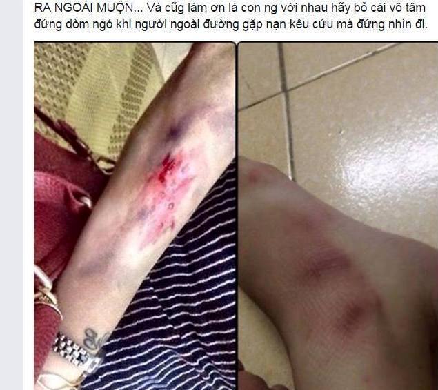 
Ngoài dòng tâm trạng, cô gái trẻ còn đăng hình ảnh các vết thương sau khi xảy ra vụ việc.
