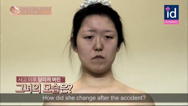 Hyun Kyung - thiếu nữ đến từ Hàn Quốc có gương mặt bị biến dạng sau tai nạn