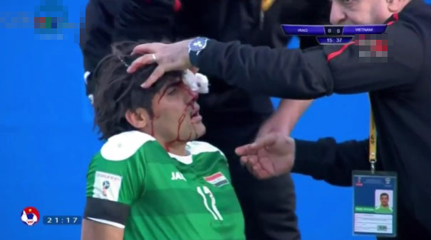 
Alaa Abdulzehra chảy rất nhiều máu vì Quế Ngọc Hải (cầu thủ SLNA chỉ bị chấn động).
