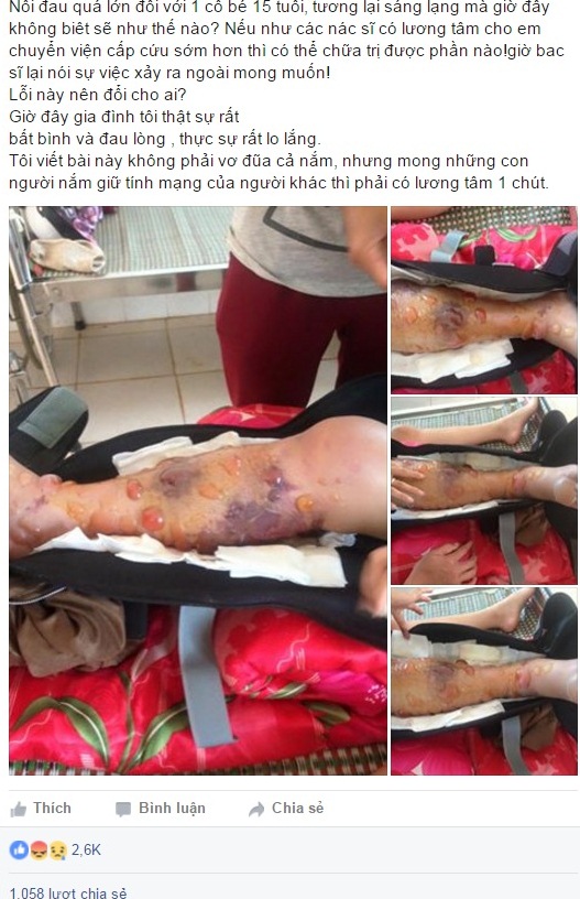 Cô gái 15 tuổi phải cưa chân sau vụ tai nạn được cho là do sự tắc trách của bác sĩ gây phẫn nộ cư dân mạng.
