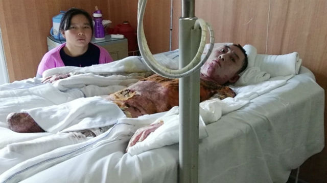 
Anh Longhua bị bỏng nặng đến 99% cơ thể và bị cưa mất chân phải sau vụ tai nạn kinh hoàng.
