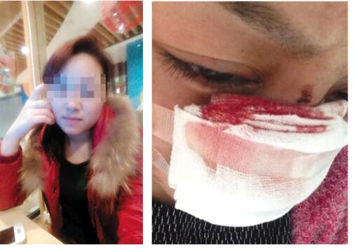 
Cô Li tiết lộ mình bị chồng cắt mũi và bạo hành nhiều lần. Ảnh: Weibo
