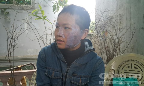 Vết thương trên má chị Hồng do bị bát inox nóng áp vào - Ảnh: Hương Nhàn
